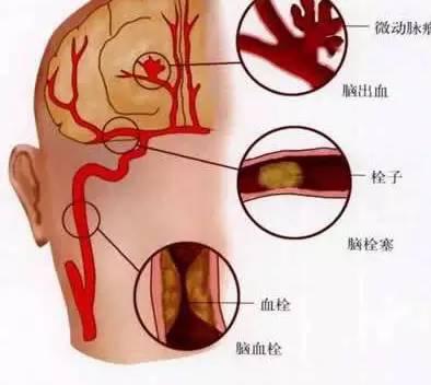 脑出血九个月，恢复与挑战